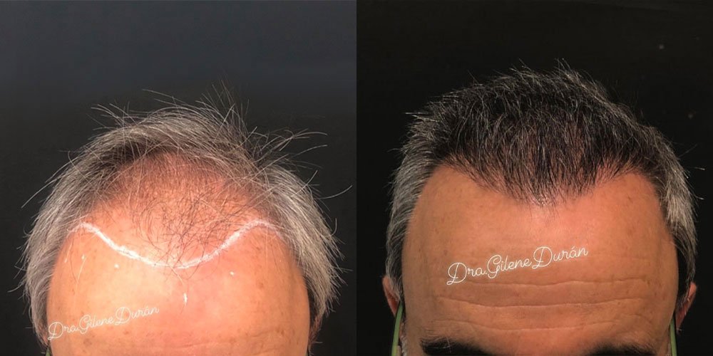 galeria_injerto-capilar_dra-gilene-duran_04