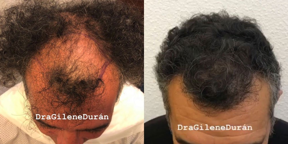 galeria_injerto-capilar_dra-gilene-duran_05