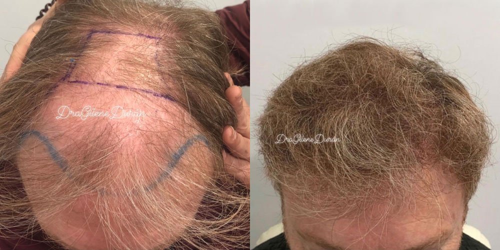 galeria_injerto-capilar_dra-gilene-duran_06