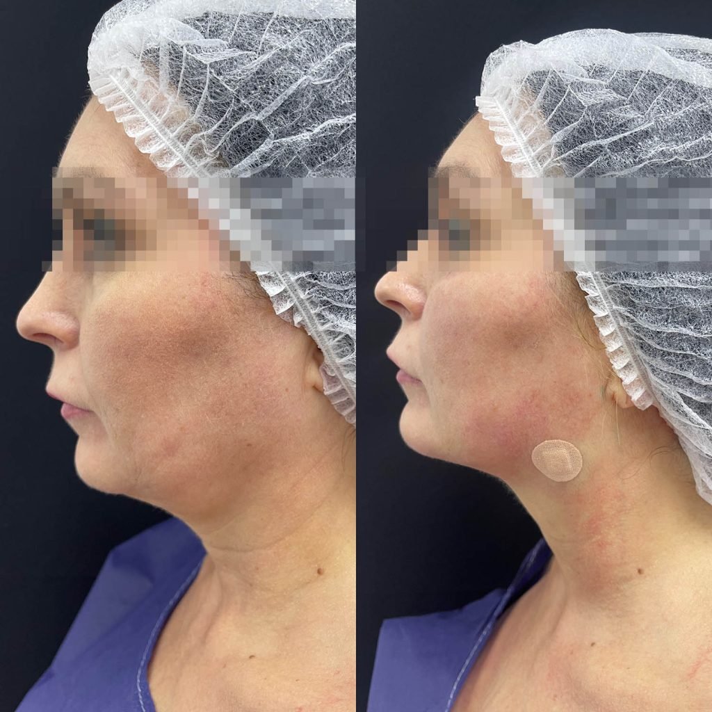 lipopapada-tensado de cuello_doctora gilene duran_medicina estetica_03