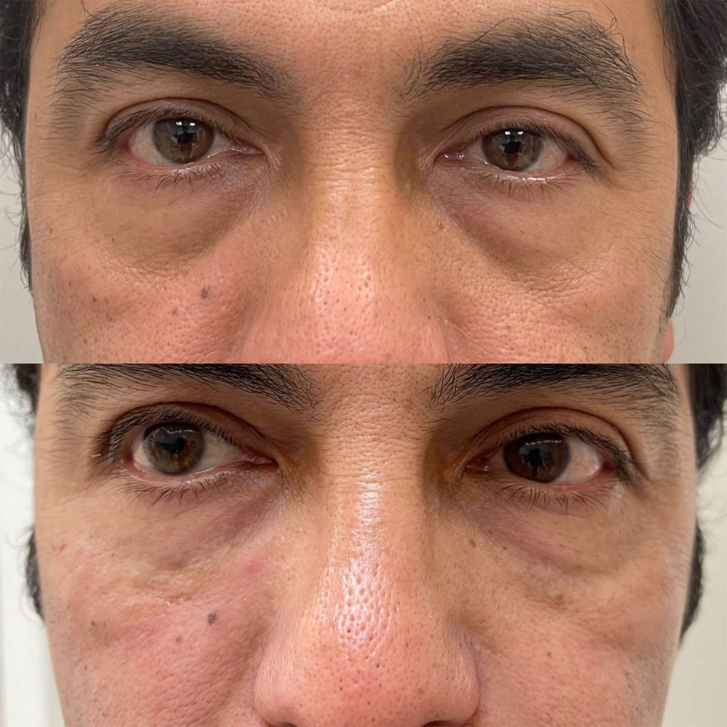 medicina estetiva-relleno de lavios y ojeras-rinomodelacion-eliminacion de arrugas-doctora gilene duran_01