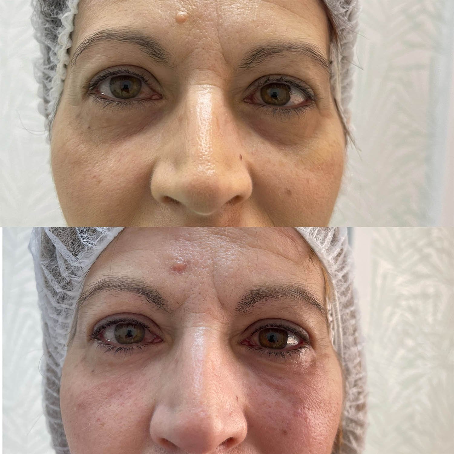 medicina estetiva-relleno de lavios y ojeras-rinomodelacion-eliminacion de arrugas-doctora gilene duran_02