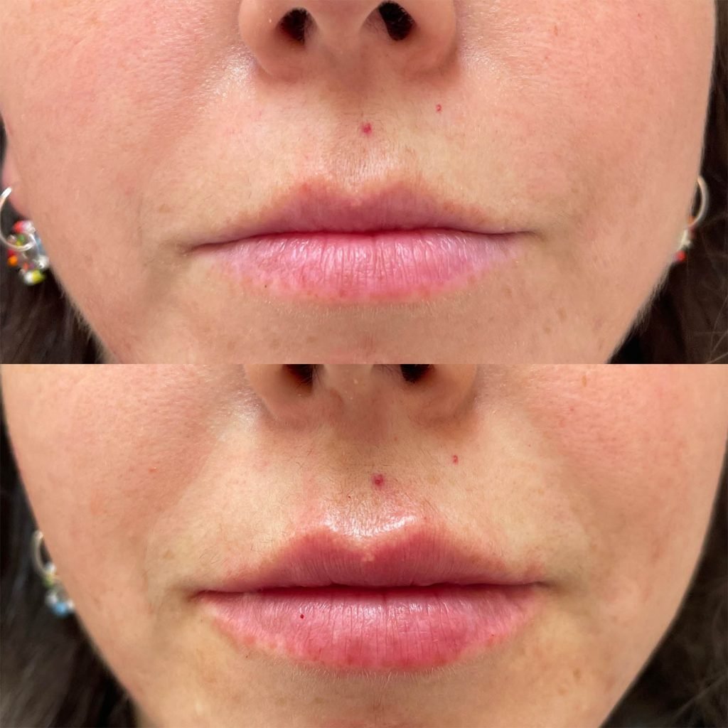 medicina estetiva-relleno de lavios y ojeras-rinomodelacion-eliminacion de arrugas-doctora gilene duran_03