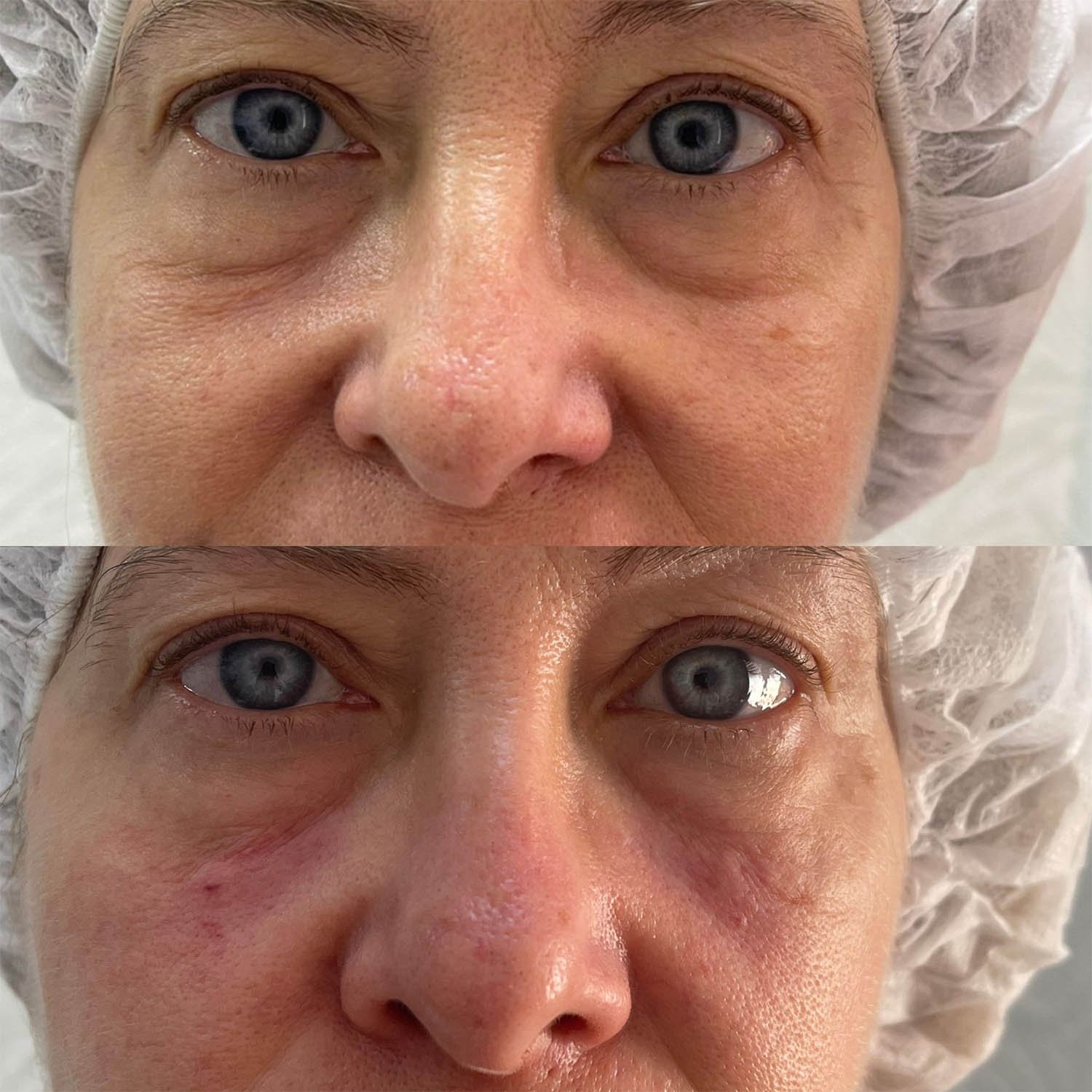 medicina estetiva-relleno de lavios y ojeras-rinomodelacion-eliminacion de arrugas-doctora gilene duran_04