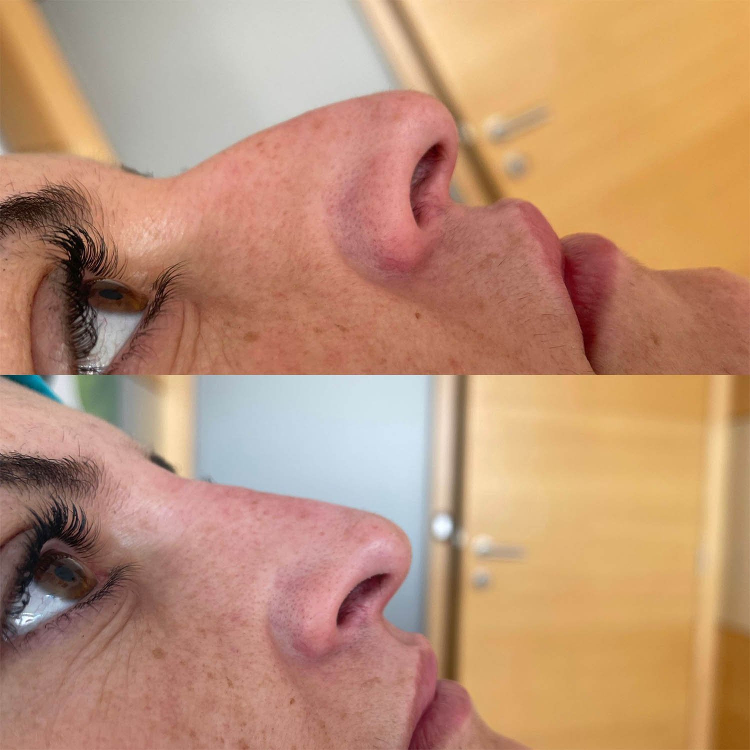 medicina estetiva-relleno de lavios y ojeras-rinomodelacion-eliminacion de arrugas-doctora gilene duran_05