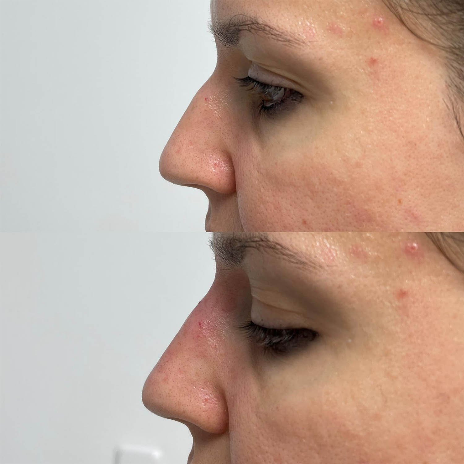 medicina estetiva-relleno de lavios y ojeras-rinomodelacion-eliminacion de arrugas-doctora gilene duran_06