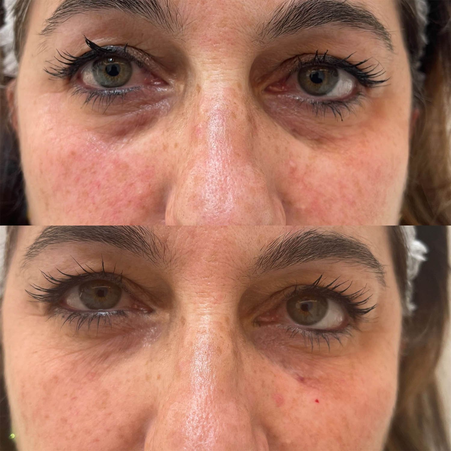 medicina estetiva-relleno de lavios y ojeras-rinomodelacion-eliminacion de arrugas-doctora gilene duran_07