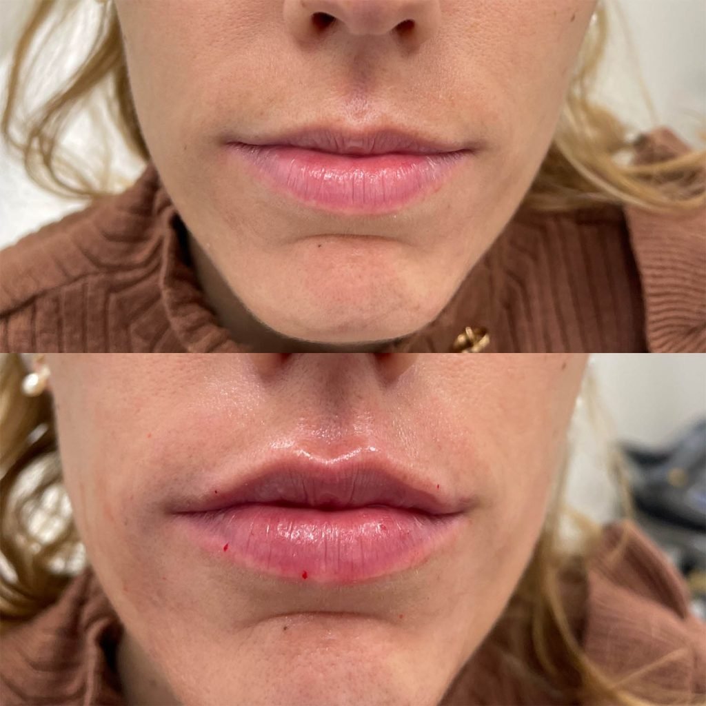 medicina estetiva-relleno de lavios y ojeras-rinomodelacion-eliminacion de arrugas-doctora gilene duran_08