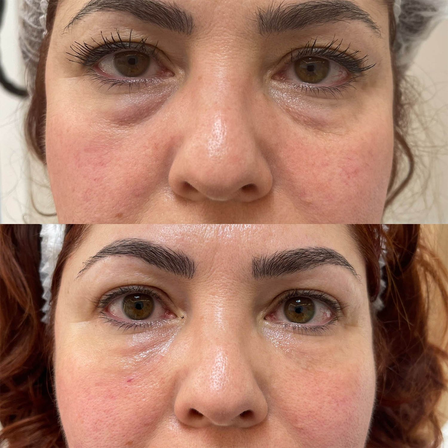 medicina estetiva-relleno de lavios y ojeras-rinomodelacion-eliminacion de arrugas-doctora gilene duran_09