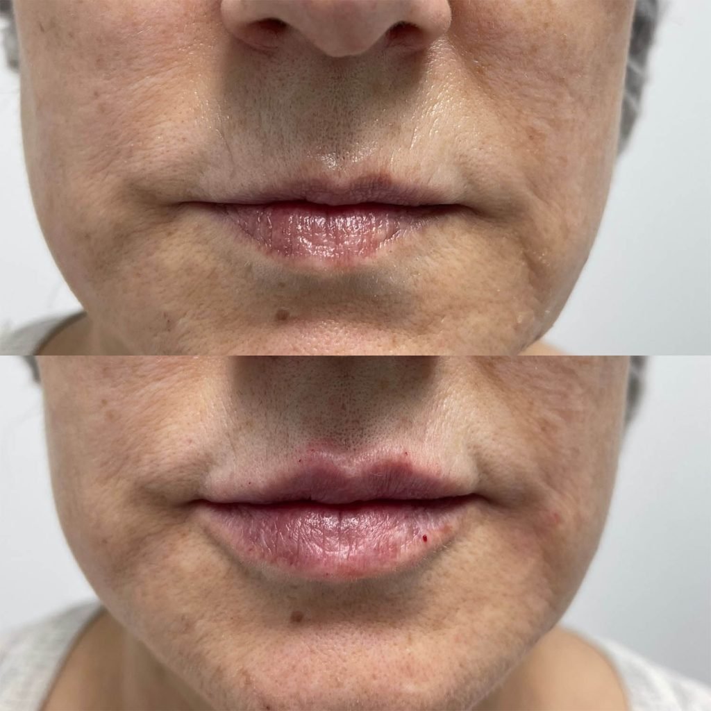 medicina estetiva-relleno de lavios y ojeras-rinomodelacion-eliminacion de arrugas-doctora gilene duran_10