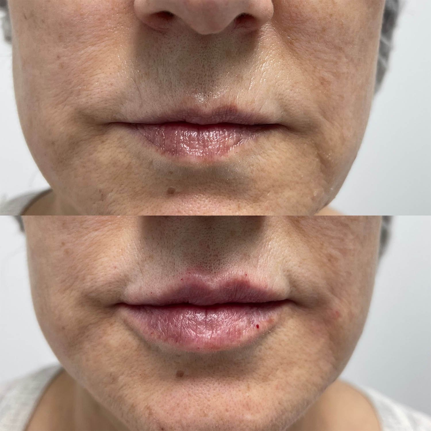 medicina estetiva-relleno de lavios y ojeras-rinomodelacion-eliminacion de arrugas-doctora gilene duran_10