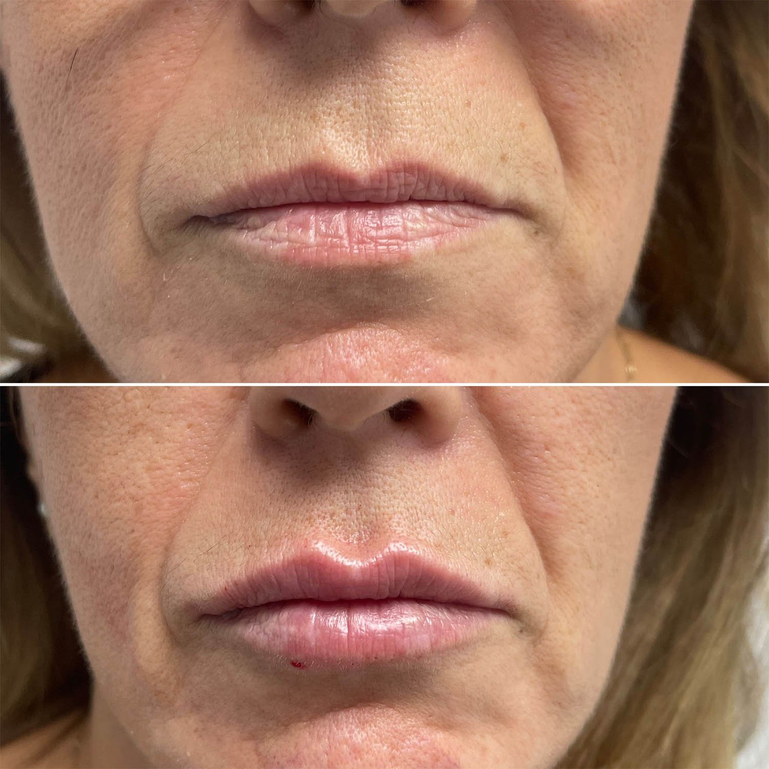 medicina estetiva-relleno de lavios y ojeras-rinomodelacion-eliminacion de arrugas-doctora gilene duran_11