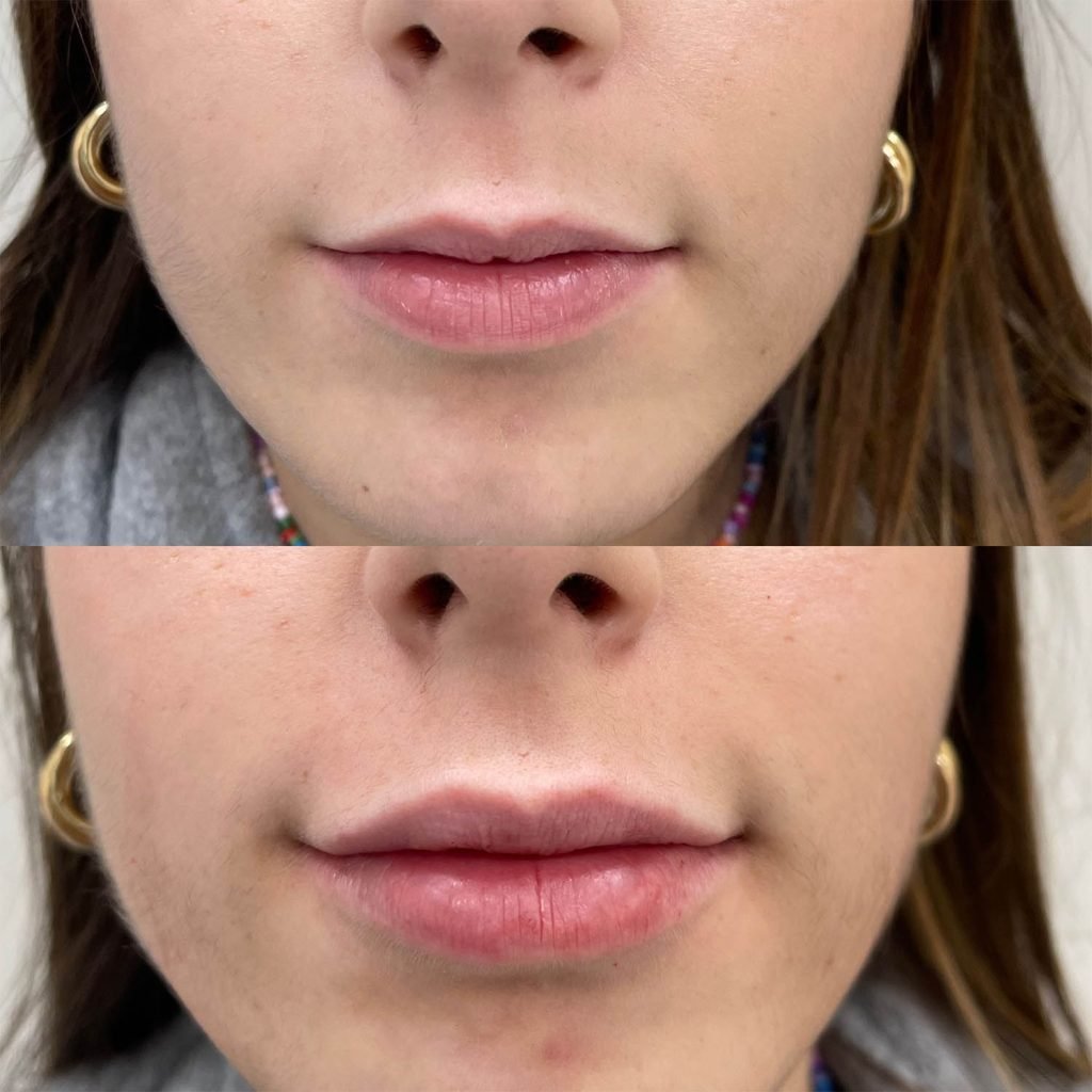 medicina estetiva-relleno de lavios y ojeras-rinomodelacion-eliminacion de arrugas-doctora gilene duran_12