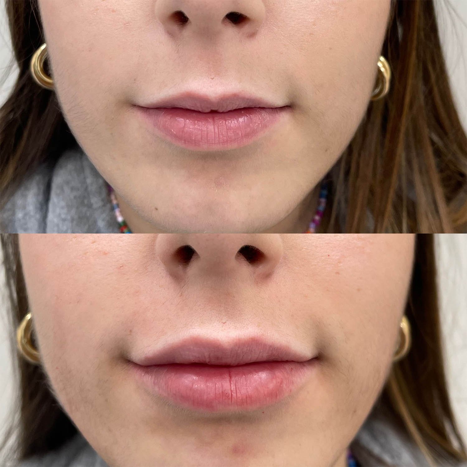 medicina estetiva-relleno de lavios y ojeras-rinomodelacion-eliminacion de arrugas-doctora gilene duran_12