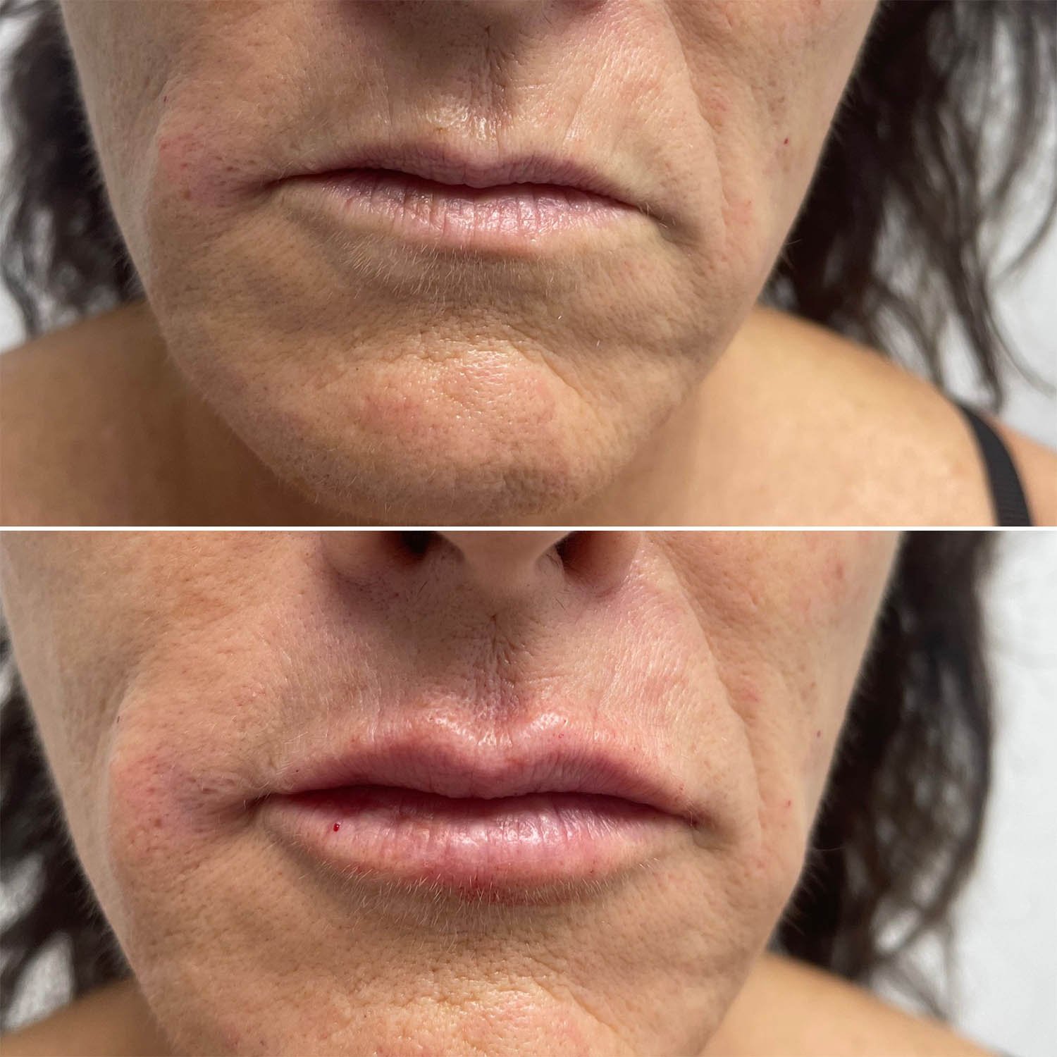 medicina estetiva-relleno de lavios y ojeras-rinomodelacion-eliminacion de arrugas-doctora gilene duran_13