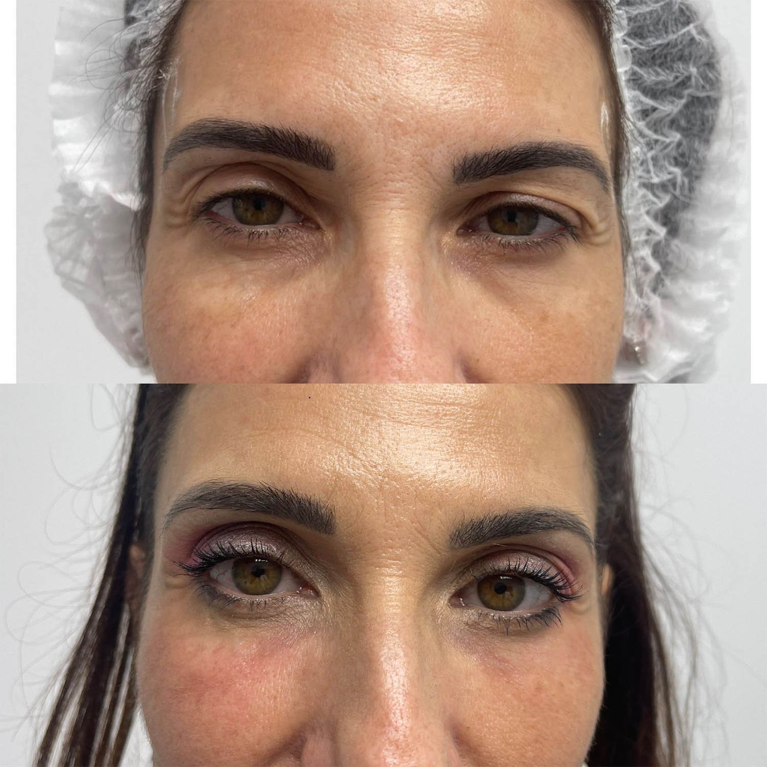 medicina estetiva-relleno de lavios y ojeras-rinomodelacion-eliminacion de arrugas-doctora gilene duran_14