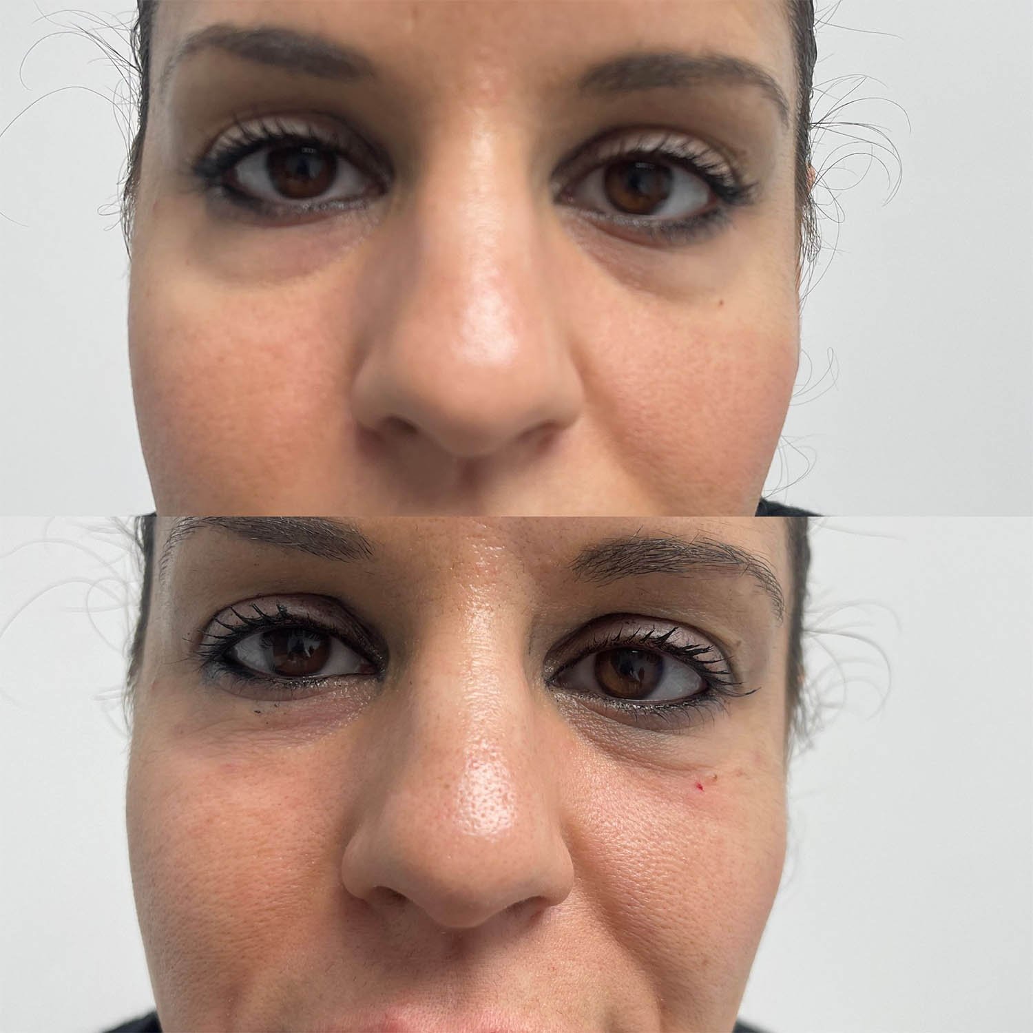 medicina estetiva-relleno de lavios y ojeras-rinomodelacion-eliminacion de arrugas-doctora gilene duran_15