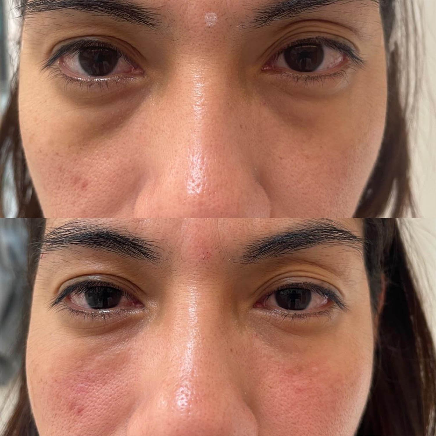 medicina estetiva-relleno de lavios y ojeras-rinomodelacion-eliminacion de arrugas-doctora gilene duran_16