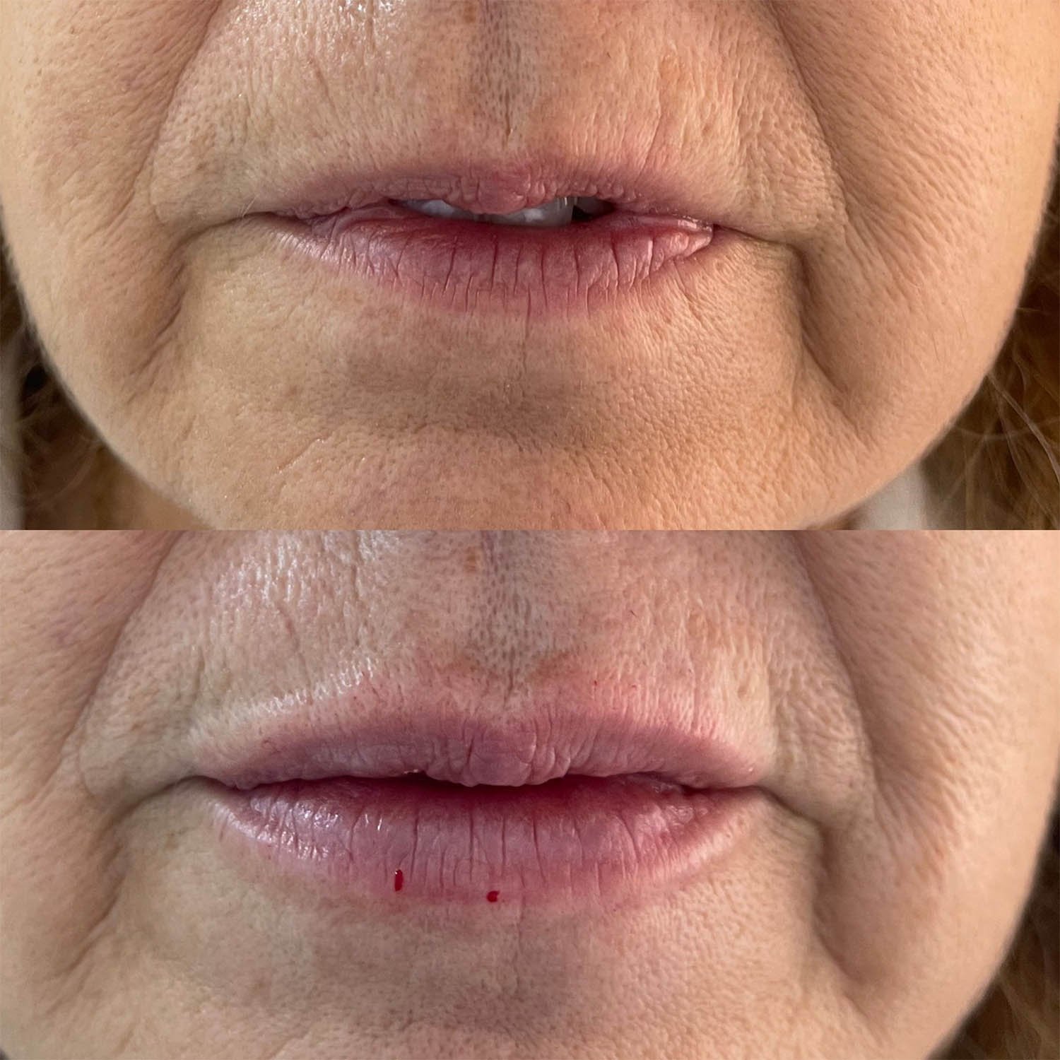 medicina estetiva-relleno de lavios y ojeras-rinomodelacion-eliminacion de arrugas-doctora gilene duran_17